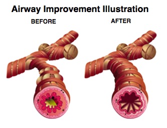 Lung Airway Before and After Salt Therapy